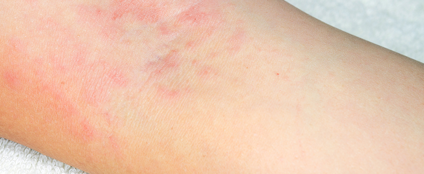 What Are the First Signs of Cellulitis? - American Family Care ...